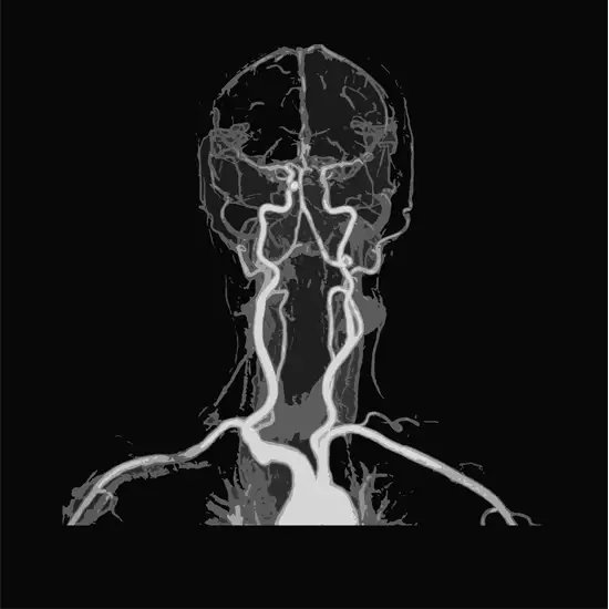 MR Angiography Neck Vessels